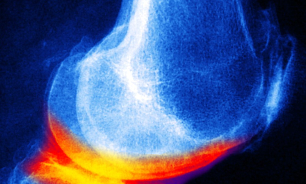Joint disease. Coloured X-ray of a knee affected by arthrosis (yellow/red, also called degenerative joint disease or osteoarthrosis), viewed from the side. The femur (thigh bone) is at top, the patella (kneecap) is seen at left, and the tibia is at bottom. Arthrosis is a progressive condition causing damage to the cartilage and bones of a joint. It can affect many different joints in the body. Risk factors are obesity, aging and the menopause. Activities involving repetitive movements can also lead to arthrosis. Treatment is with anti-inflammatory drugs and, in severe cases, surgery.