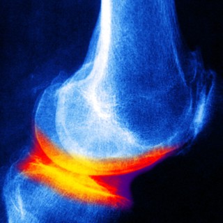 Joint disease. Coloured X-ray of a knee affected by arthrosis (yellow/red, also called degenerative joint disease or osteoarthrosis), viewed from the side. The femur (thigh bone) is at top, the patella (kneecap) is seen at left, and the tibia is at bottom. Arthrosis is a progressive condition causing damage to the cartilage and bones of a joint. It can affect many different joints in the body. Risk factors are obesity, aging and the menopause. Activities involving repetitive movements can also lead to arthrosis. Treatment is with anti-inflammatory drugs and, in severe cases, surgery.